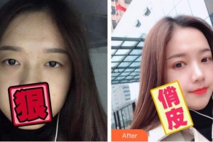 臺州國際眼科醫(yī)院姜儉整形價(jià)格表附切開雙眼皮案例展示
