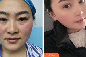 臺州國際眼科醫(yī)院丁陽整形價(jià)格表附外切祛眼袋案例展示