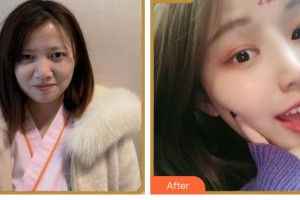 臺州國際眼科醫(yī)院卓佐跑整形價(jià)格表附眼部綜合案例展示