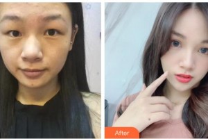 臺州國際眼科醫(yī)院鄭丹整形價(jià)格表附激光去眼袋案例展示