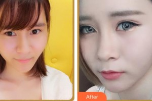 臺州國際眼科醫(yī)院張美君整形價(jià)格表附眼部綜合案例展示