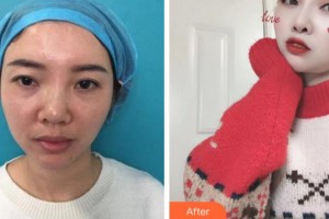 臺州國際眼科醫(yī)院馬慧香整形價格表附眼部修復案例展示