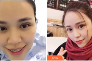 臺州國際眼科醫(yī)院余新平整形價格表附切開雙眼皮案例展示