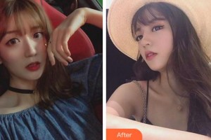 臺州國際眼科醫(yī)院于旭東整形價格表附切開雙眼皮案例展示