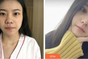 臺州國際眼科醫(yī)院汪育文整形價格表附切開雙眼皮案例展示