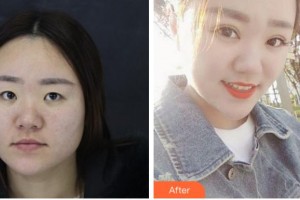 臺州國際眼科醫(yī)院鄧如芝整形價格表附眼部修復案例展示