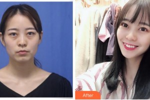 臺州妍度醫(yī)療美容門診部應建軍整形價格表附眼部綜合案例展示