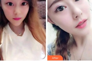 臺州康貝佳口腔醫(yī)院阿諾德.馬丁整形價格表附牙貼面案例展示