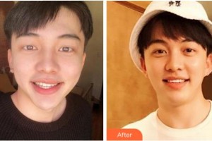 臺(tái)州康貝佳口腔醫(yī)院吳品芳整形價(jià)格表附美白貼片案例展示