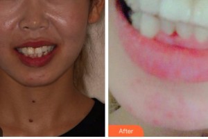 臺(tái)州康貝佳口腔醫(yī)院趙潤(rùn)植整形價(jià)格表附牙齒隱形矯正案例展示