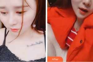 臺(tái)州康貝佳口腔醫(yī)院余新統(tǒng)整形價(jià)格表附超聲波潔牙案例展示