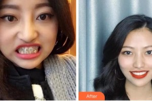 臺(tái)州康貝佳口腔醫(yī)院岳巍娜整形價(jià)格表附牙齒陶瓷矯正案例展示