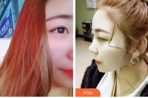 臺州康貝佳口腔醫(yī)院阮利芳整形價格表附超聲波潔牙案例展示