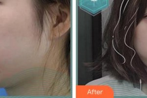 麗水樊承紅醫(yī)療美容診所沈月霞整形價(jià)格表附肋軟骨隆鼻案例展示