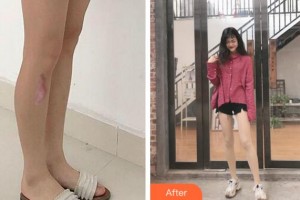 麗水市人民醫(yī)院整形燒傷外科朱薛峰整形價(jià)格表附激光祛疤案例展示