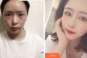 麗水慈愛(ài)醫(yī)院整形美容中心鄭承鎬整形價(jià)格表附眼部綜合案例展示