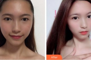 麗水慈愛(ài)醫(yī)院整形美容中心李柄旭整形價(jià)格表附眼部綜合案例展示