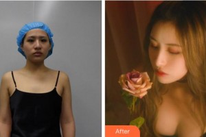 麗水慈愛(ài)醫(yī)院整形美容中心樸永佑整形價(jià)格表附自體脂肪隆胸案例展示