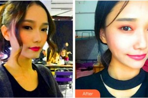 四川華美紫馨醫(yī)學(xué)美容醫(yī)院劉會(huì)省整形價(jià)格表附熱瑪吉案例展示