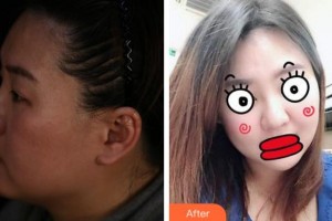 四川華人醫(yī)聯(lián)整形美容醫(yī)院游曉波整形價(jià)格表附埋線提升案例展示