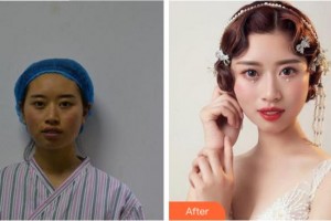 四川省人民醫(yī)院整形外科盧帆整形價(jià)格表附抗衰案例展示