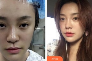 四川省人民醫(yī)院整形外科衛(wèi)東整形價格表附埋線提升案例展示