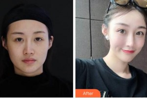 四川省人民醫(yī)院整形外科傅榮整形價(jià)格表附埋線提升案例展示