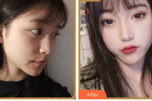 四川省人民醫(yī)院整形外科鐘雷整形價(jià)格表附埋線提升案例展示