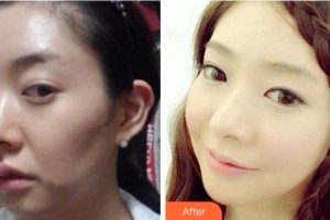 四川省人民醫(yī)院整形外科杜麗平整形價(jià)格表附埋線提升案例展示