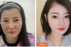 四川省人民醫(yī)院整形外科蔡震整形價格表附熱瑪吉案例展示