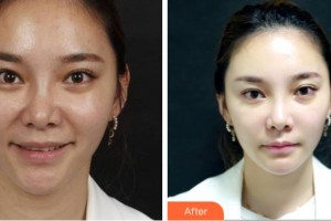 四川武警總隊(duì)醫(yī)院樂山分院燒傷整形科余順先整形價(jià)格表附熱瑪吉案例展示