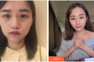 四川武警總隊(duì)醫(yī)院樂山分院燒傷整形科袁文周整形價格表附熱瑪吉案例展示