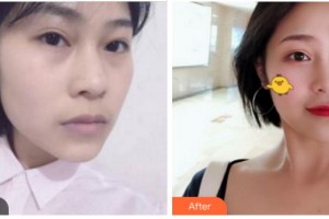 四川武警總隊(duì)醫(yī)院樂山分院燒傷整形科帥秀蓉整形價格表附埋線提升案例展示