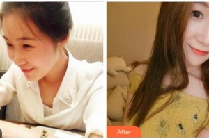 四川美萊醫(yī)學(xué)美容醫(yī)院李殷政整形價(jià)格表附熱瑪吉案例展示