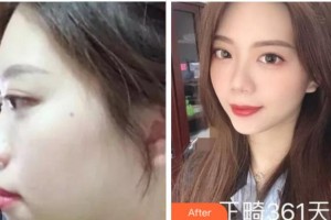 四川美萊醫(yī)學(xué)美容醫(yī)院吳幼文整形價(jià)格表附金屬托槽矯正案例展示