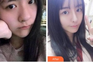 四川華人醫(yī)聯(lián)整形美容醫(yī)院張叔平整形價(jià)格表附熱瑪吉案例展示