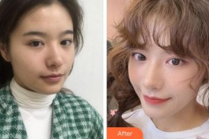 四川大學(xué)華西口腔醫(yī)院美容中心余自能整形價(jià)格表附熱瑪吉案例展示