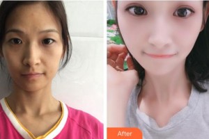 四川西嬋整形美容醫(yī)院劉輔蓉整形價(jià)格表附眼部綜合案例展示