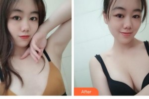 四川西嬋整形美容醫(yī)院黃亮整形價(jià)格表附自體脂肪隆胸案例展示