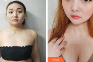 四川西嬋整形美容醫(yī)院黃富偉住院醫(yī)師整形價(jià)格表附自體脂肪隆胸案例展示