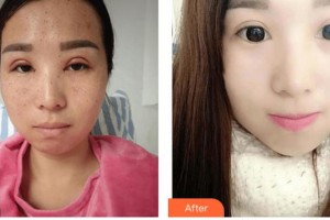 四川西嬋整形美容醫(yī)院楊海皎整形價(jià)格表附皮膚管理案例展示