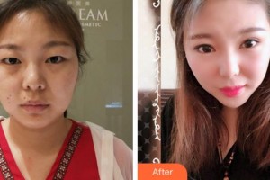 四川西嬋整形美容醫(yī)院樊明山整形價(jià)格表附激光祛斑案例展示