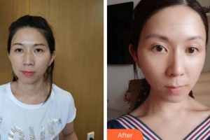 四川圣麗整形美容醫(yī)院劉晶整形價(jià)格表附熱拉提案例展示