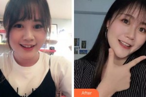 四川華人醫(yī)聯(lián)整形美容醫(yī)院成偉整形價(jià)格表附金屬托槽矯正案例展示