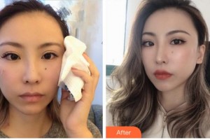 四川華人醫(yī)聯(lián)整形美容醫(yī)院黃偉整形價格表附埋線提升案例展示