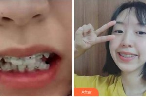 四川華人醫(yī)聯(lián)整形美容醫(yī)院彭忠倩整形價(jià)格表附牙齒陶瓷矯正案例展示