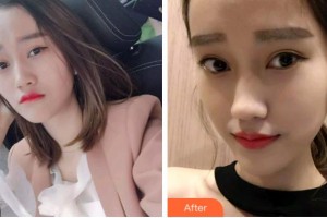 四川華人醫(yī)聯(lián)整形美容醫(yī)院朱文超整形價(jià)格表附牙齒隱形矯正案例展示