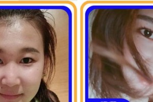 四川省紅十字腫瘤醫(yī)院整形科林強(qiáng)整形價(jià)格表附硅膠隆鼻案例展示