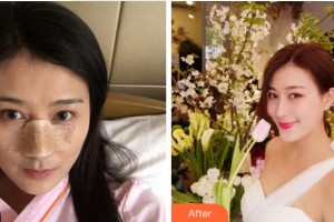 四川省紅十字腫瘤醫(yī)院整形科張大紅整形價(jià)格表附鼻部綜合案例展示