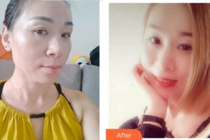 四川華美紫馨醫(yī)學(xué)美容醫(yī)院趙瓊英整形價格表附激光祛斑案例展示